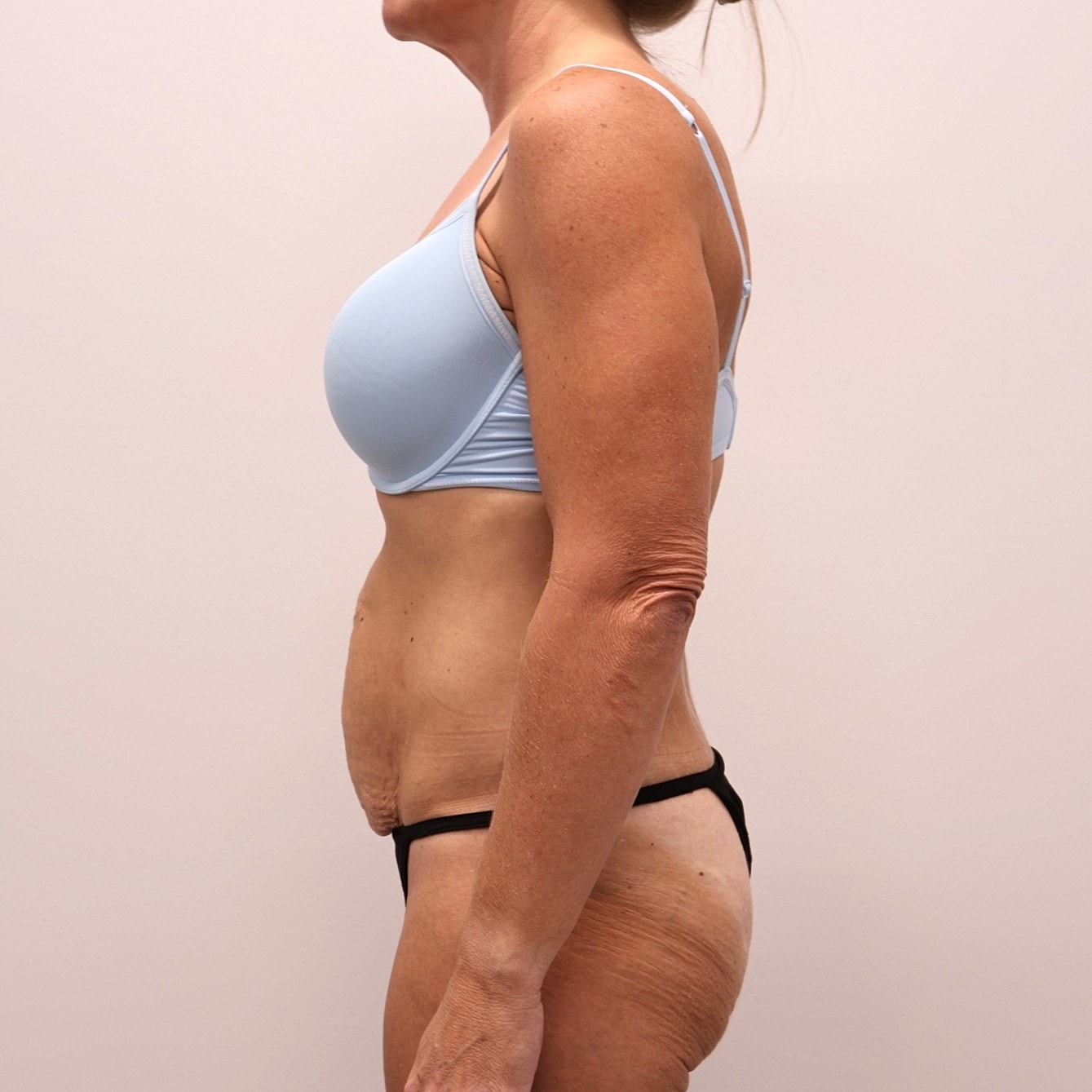 Tummy Tuck Before & After