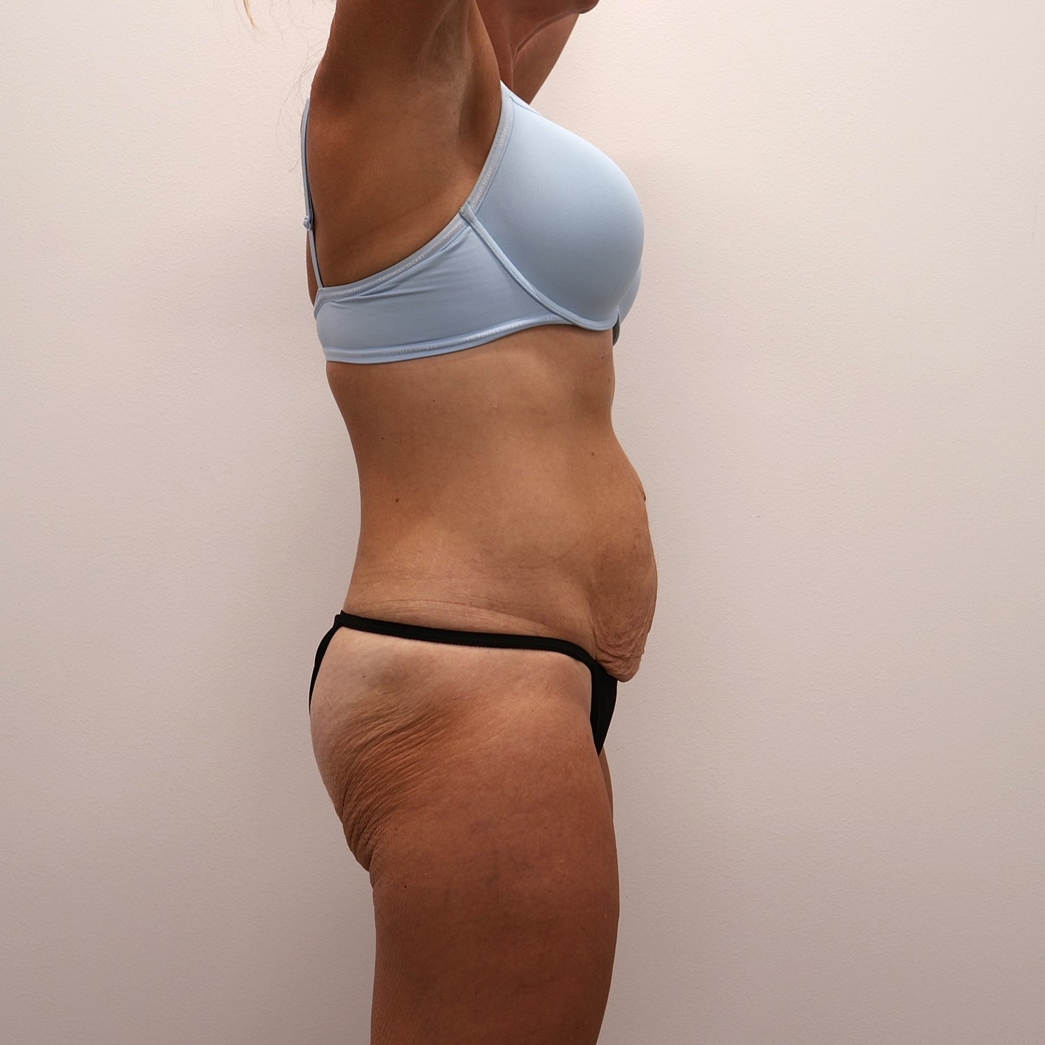 Tummy Tuck Before & After