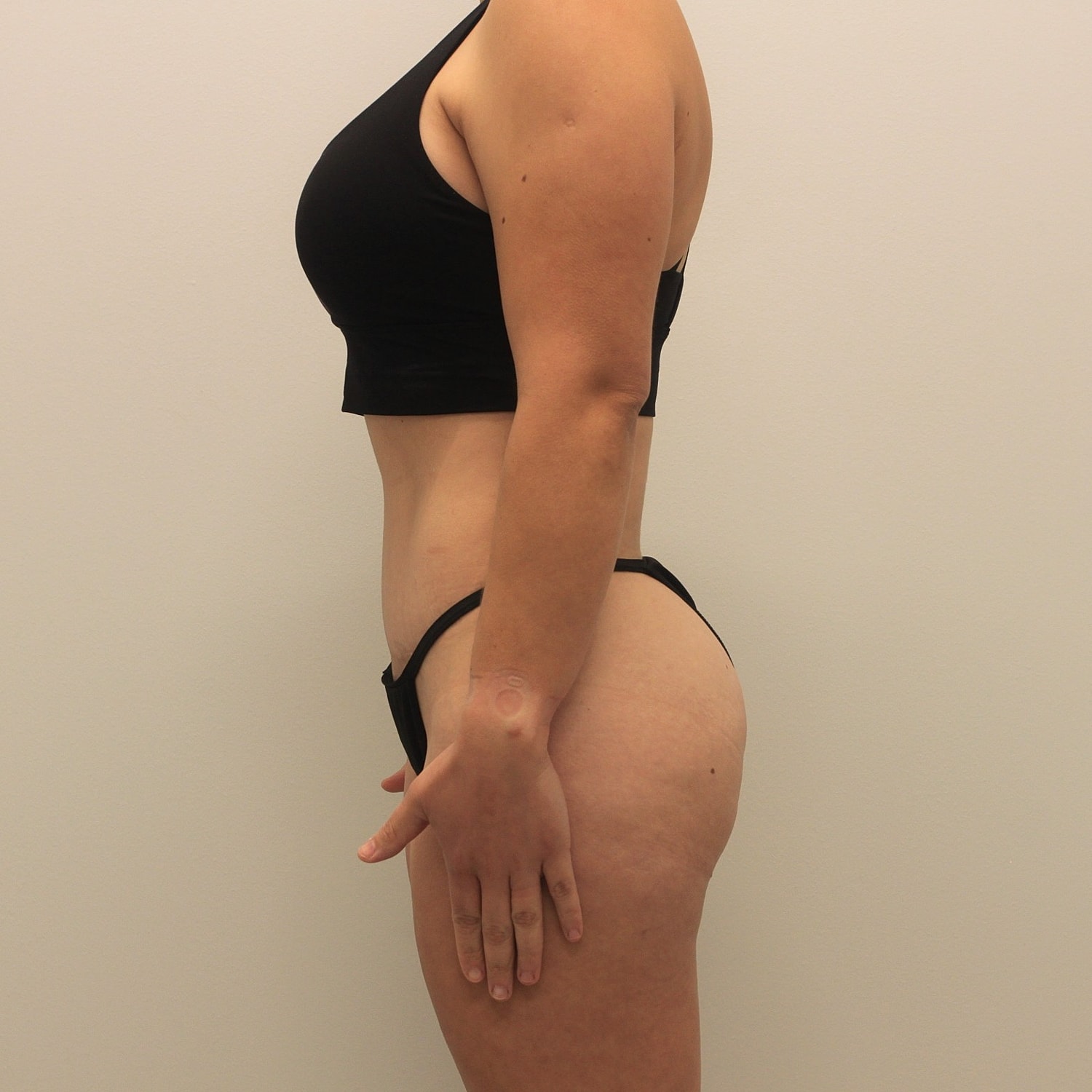 Tummy Tuck Before & After