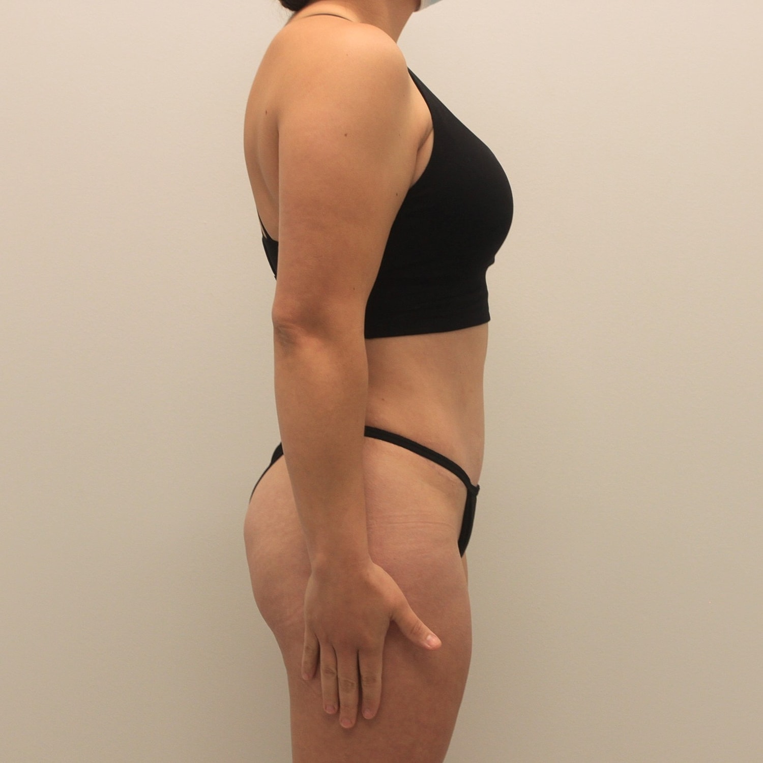 Tummy Tuck Before & After