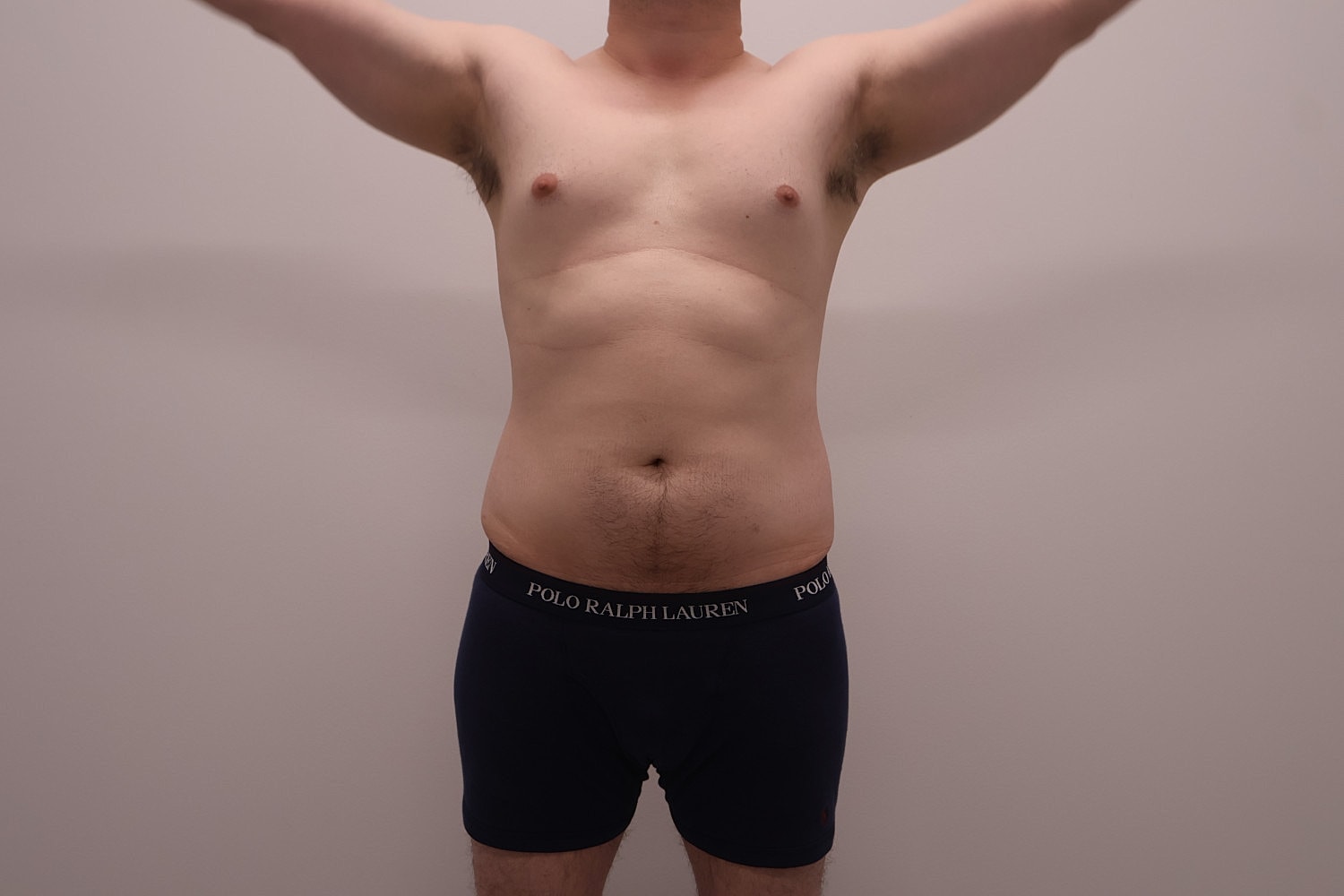 Male Body Contouring Before & After