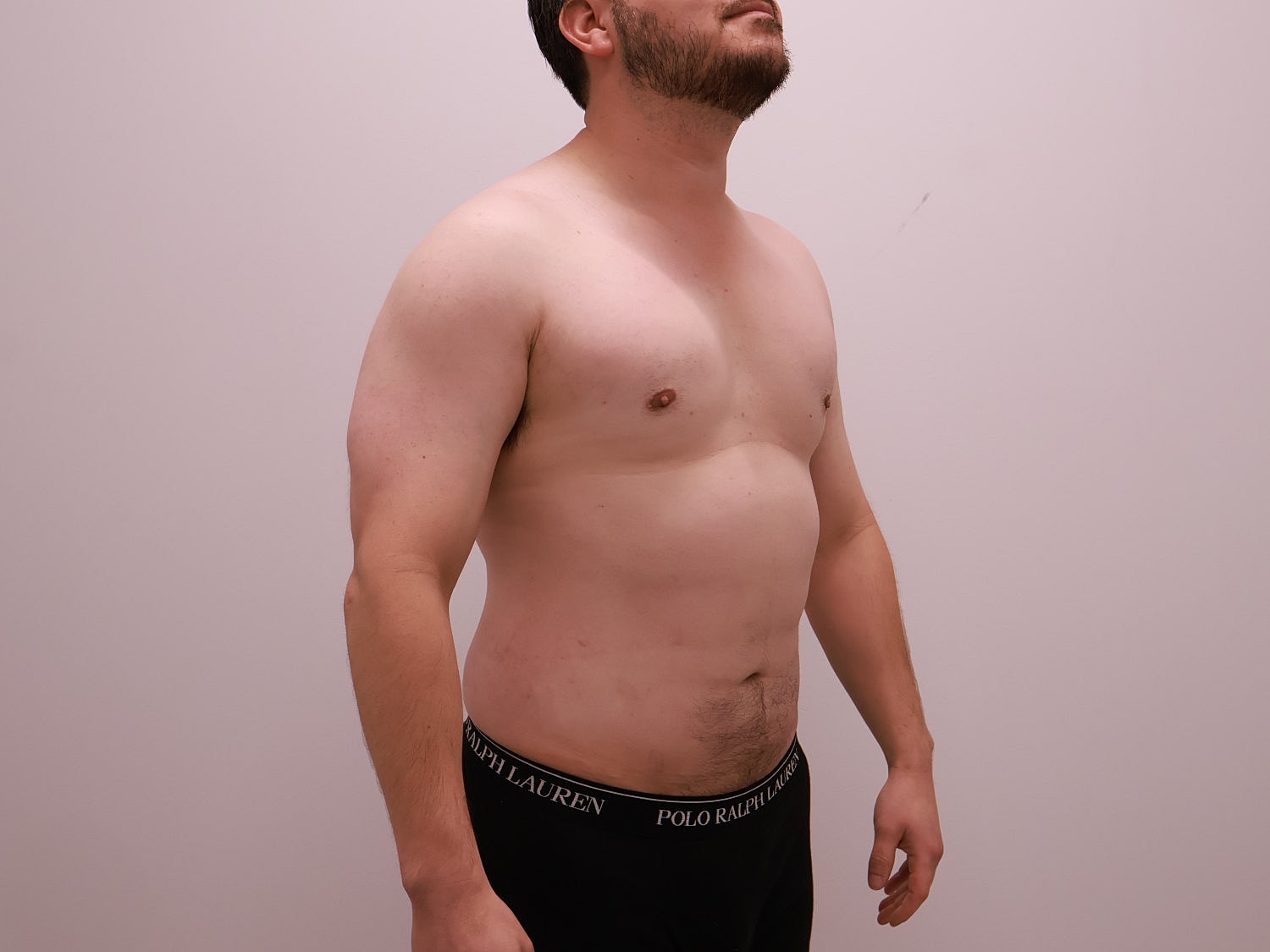 Male Body Contouring Before & After