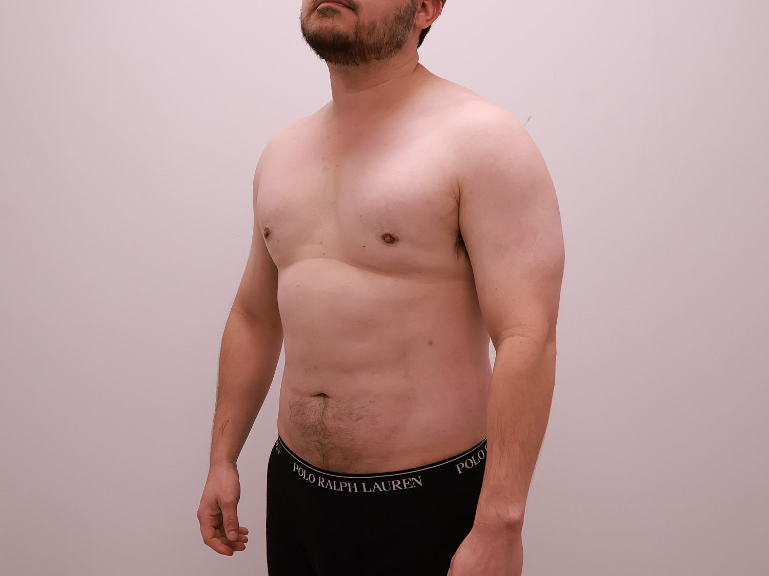 Male Body Contouring Before & After