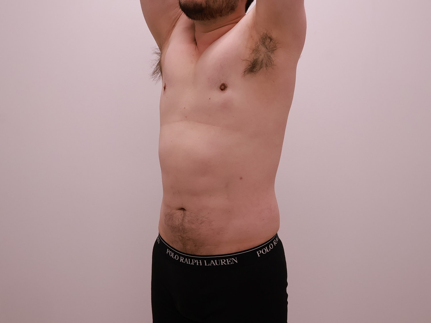 Male Body Contouring Before & After