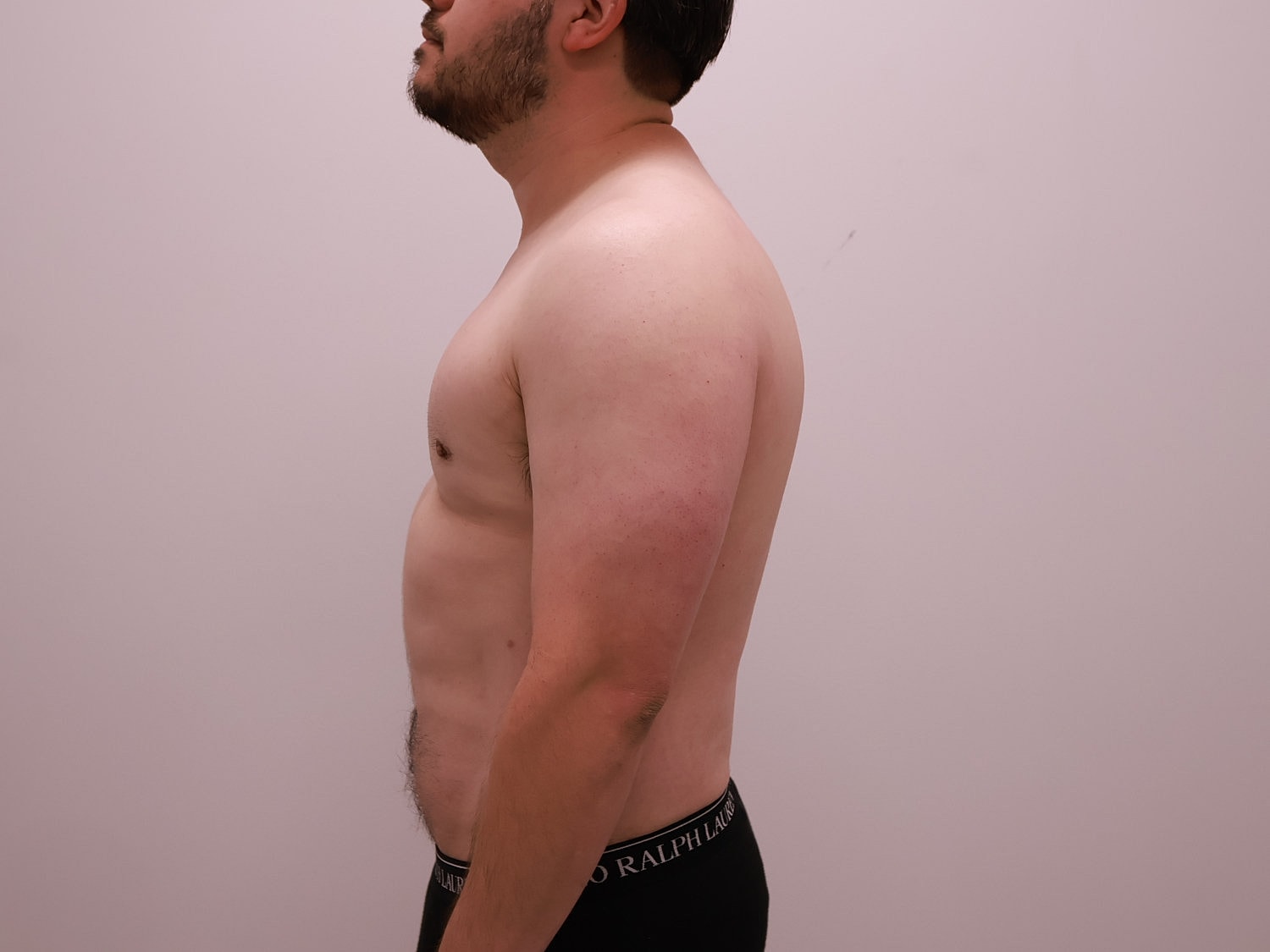 Male Body Contouring Before & After