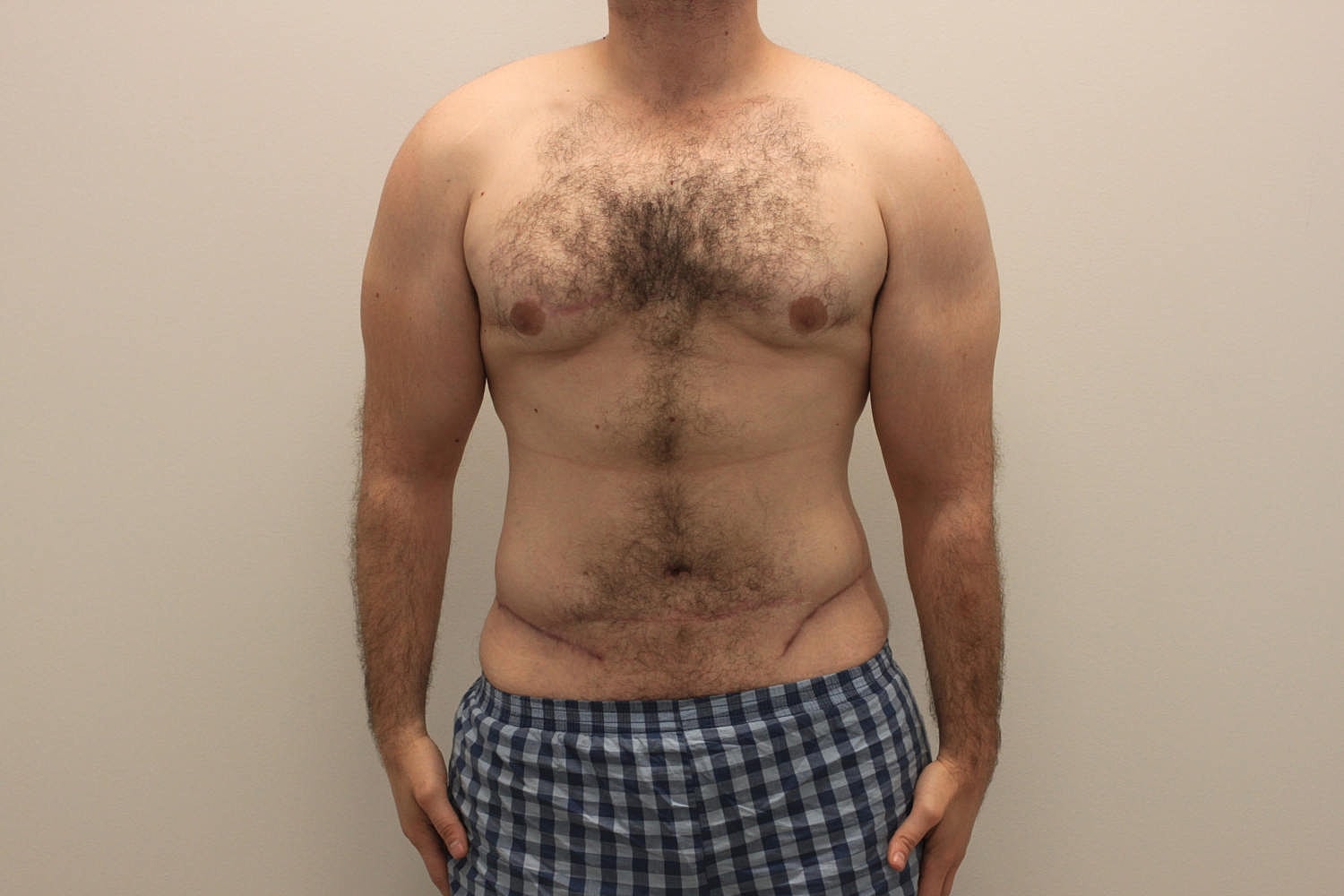 Male Body Contouring Before & After
