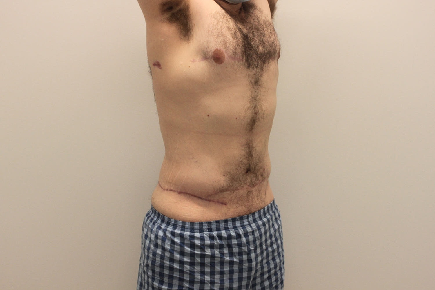 Male Body Contouring Before & After