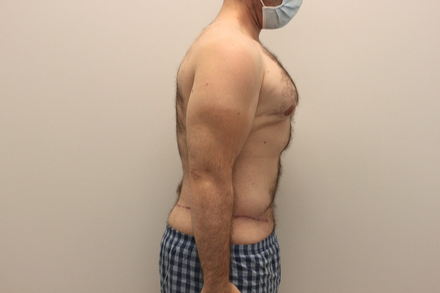 Male Body Contouring Before & After