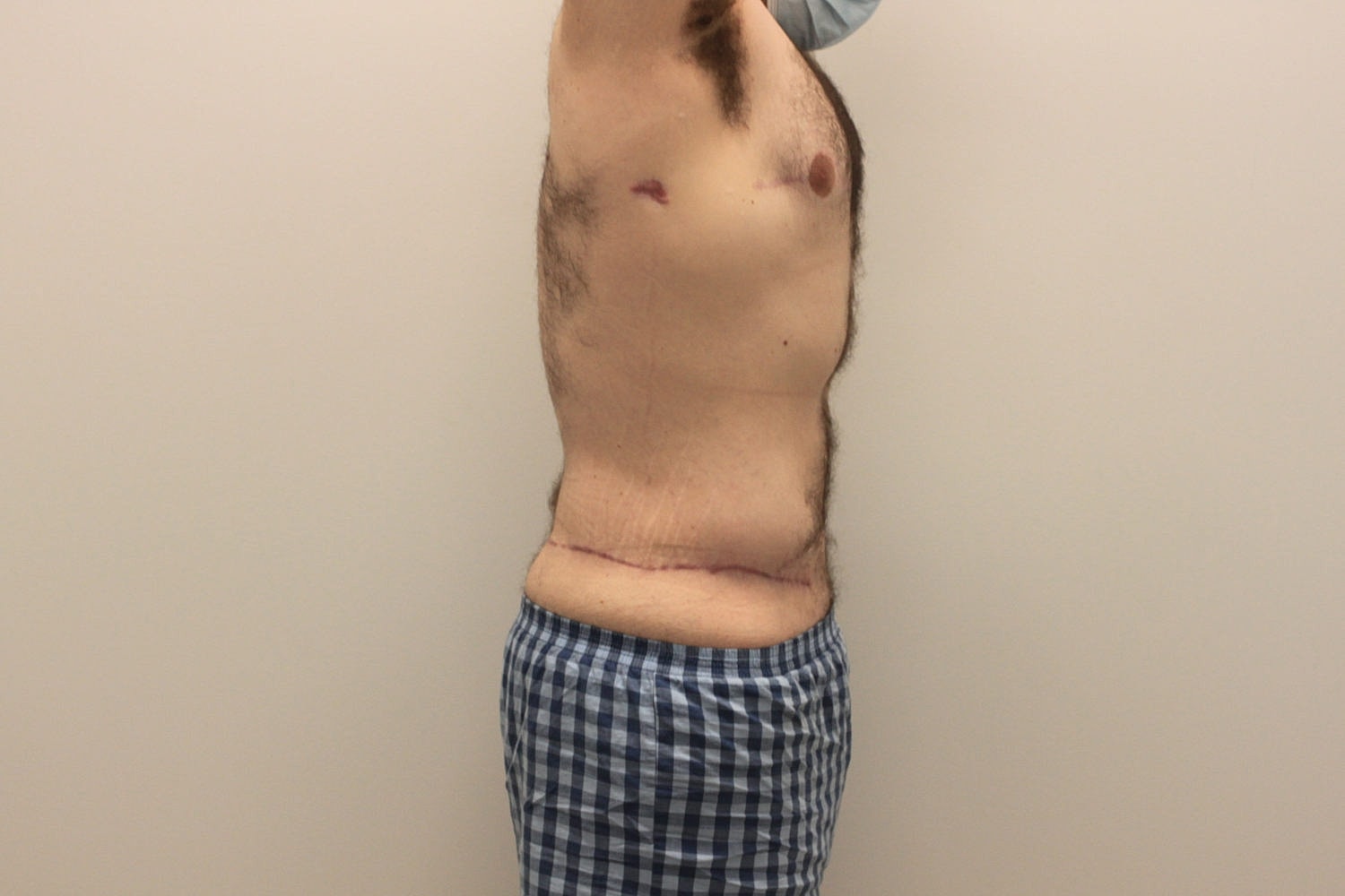 Male Body Contouring Before & After