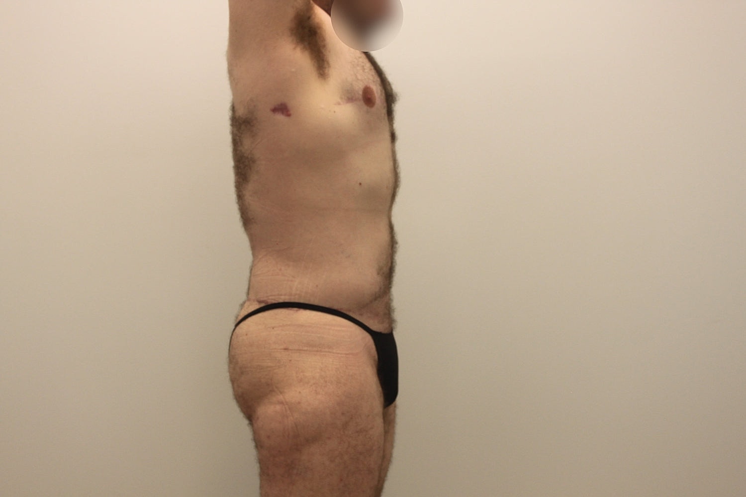 Male Body Contouring Before & After