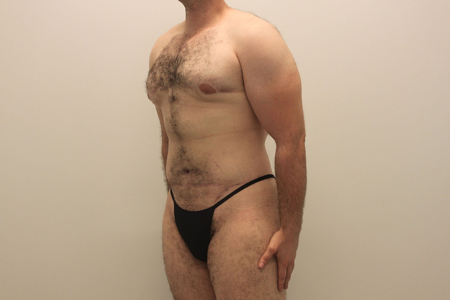 Male Body Contouring Before & After