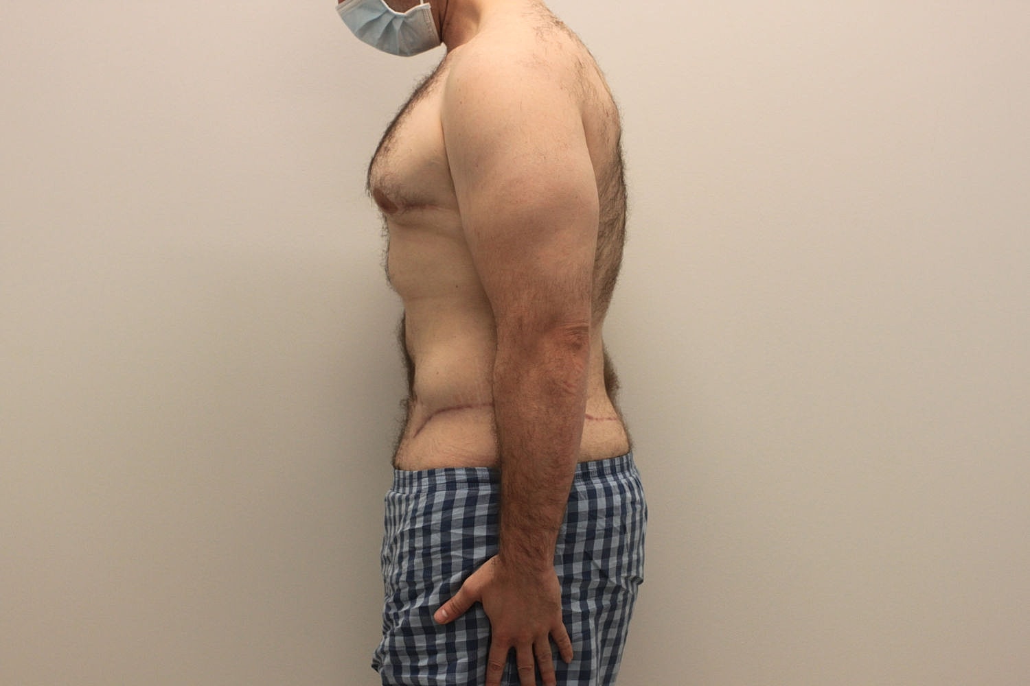 Male Body Contouring Before & After