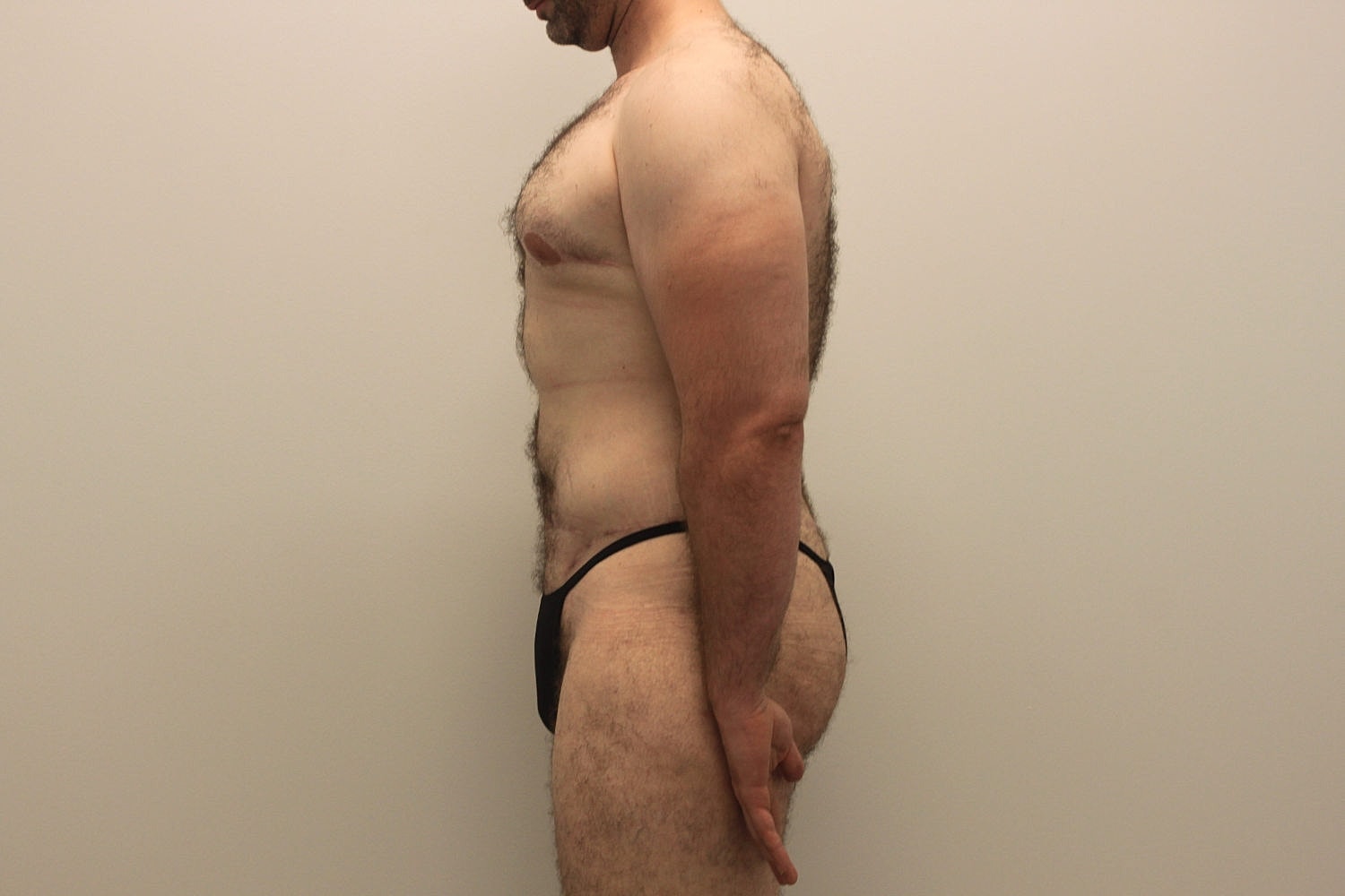 Male Body Contouring Before & After