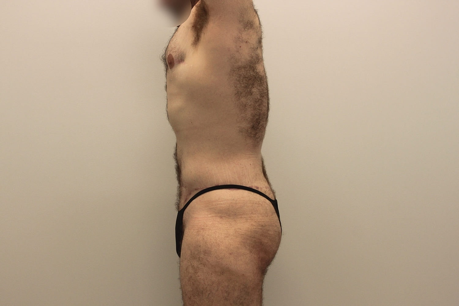 Male Body Contouring Before & After