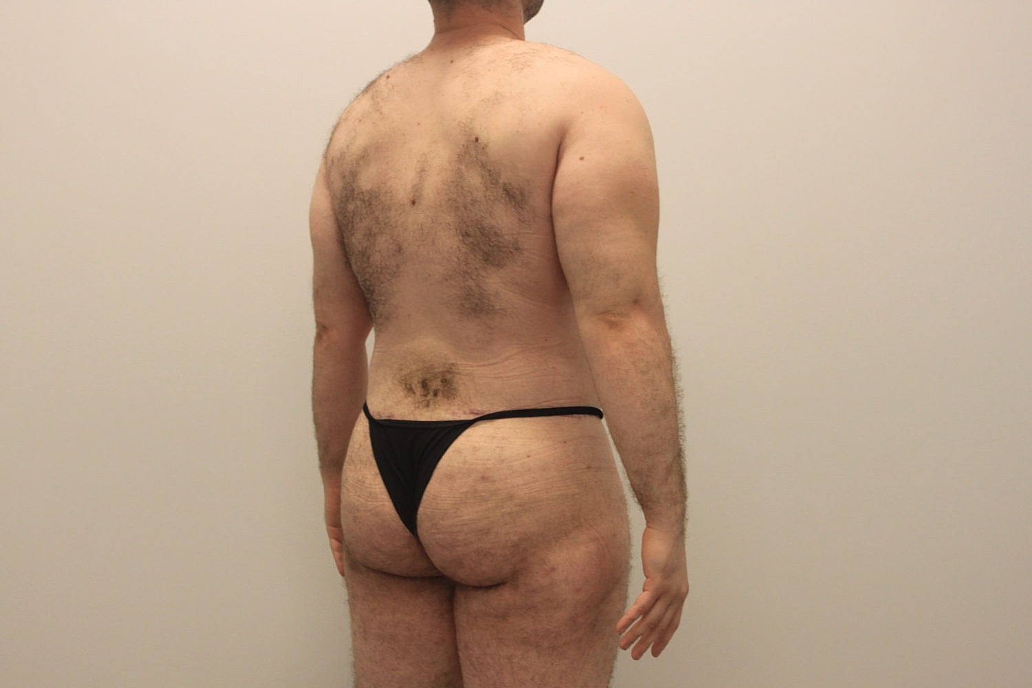 Male Body Contouring Before & After