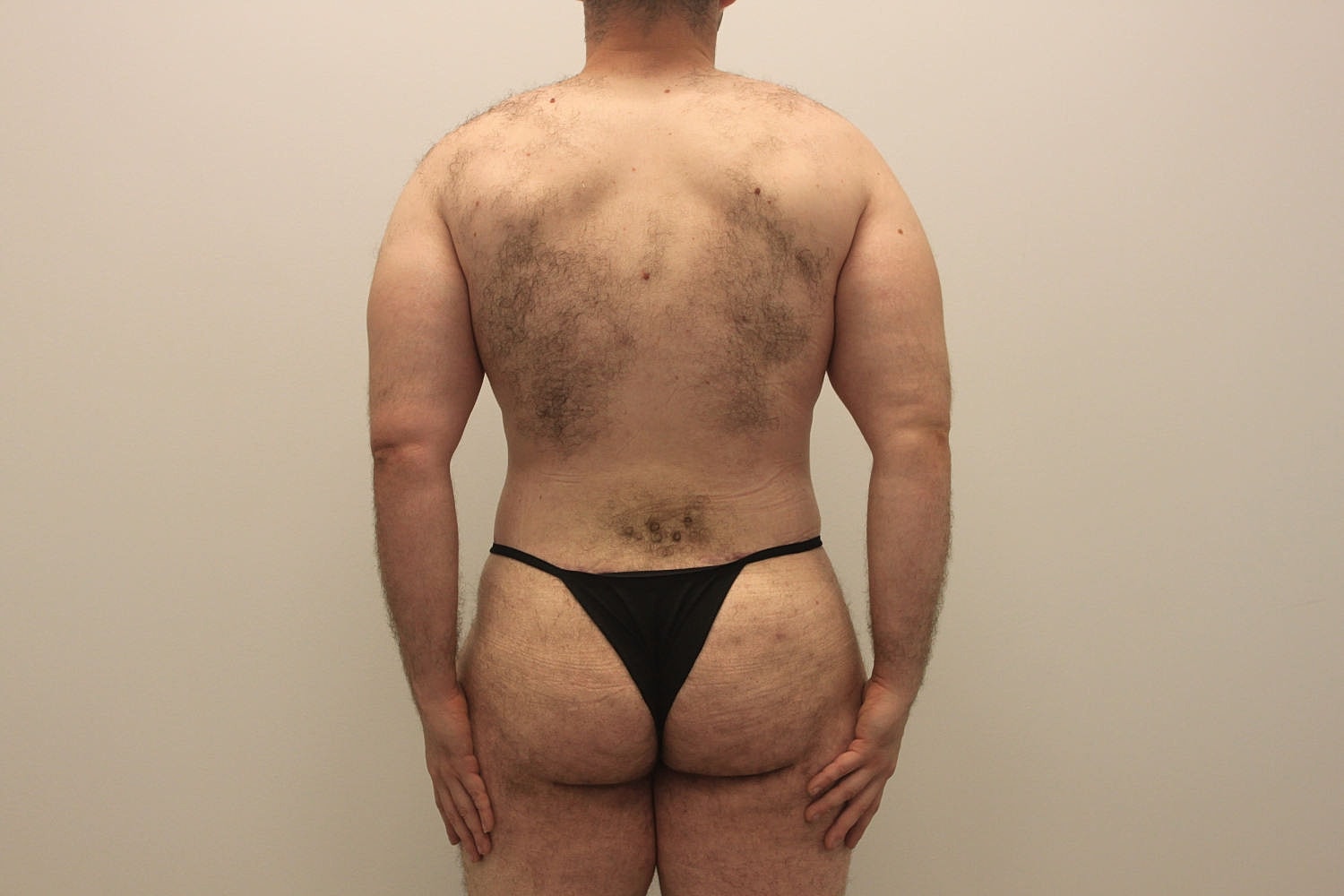 Male Body Contouring Before & After