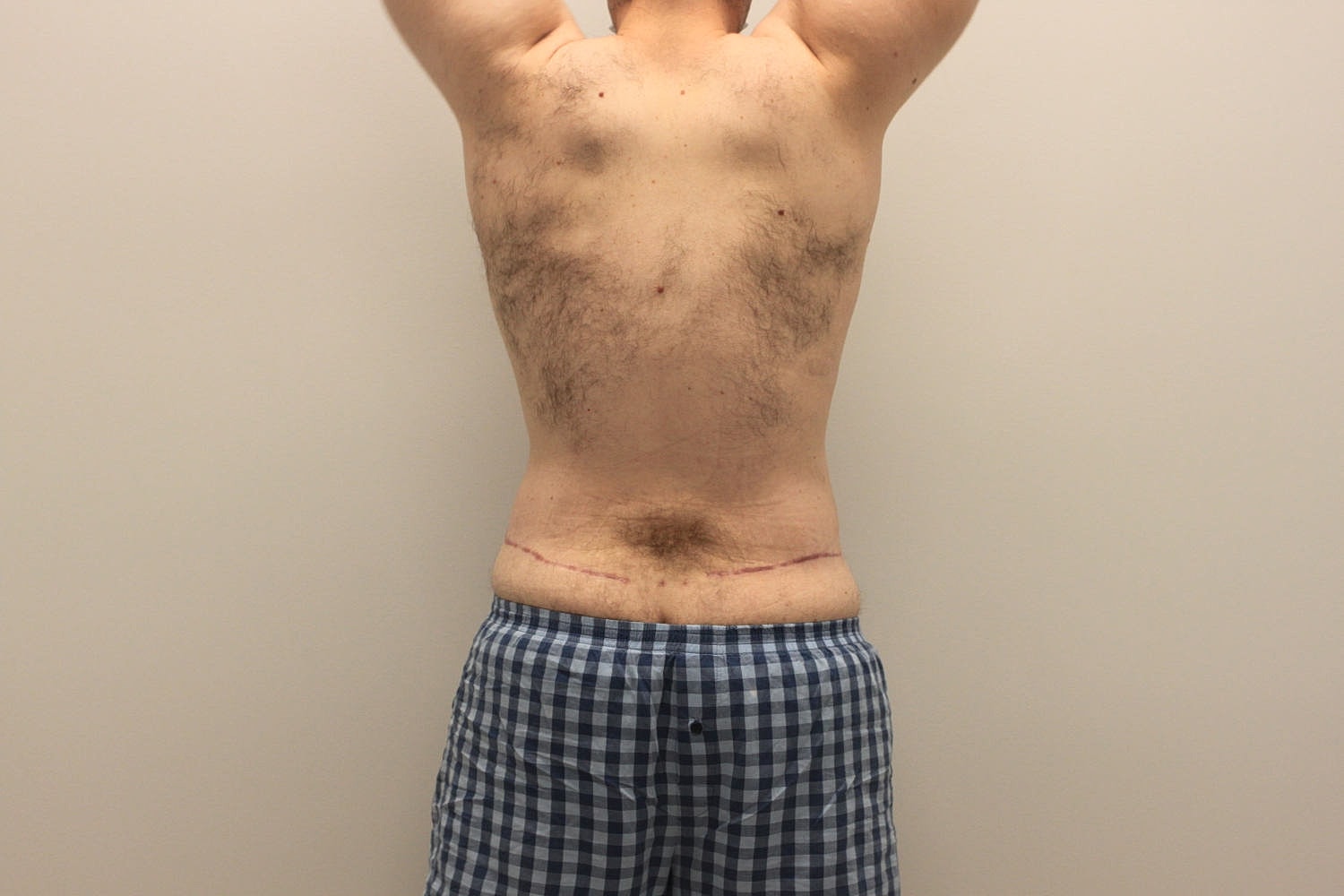 Male Body Contouring Before & After