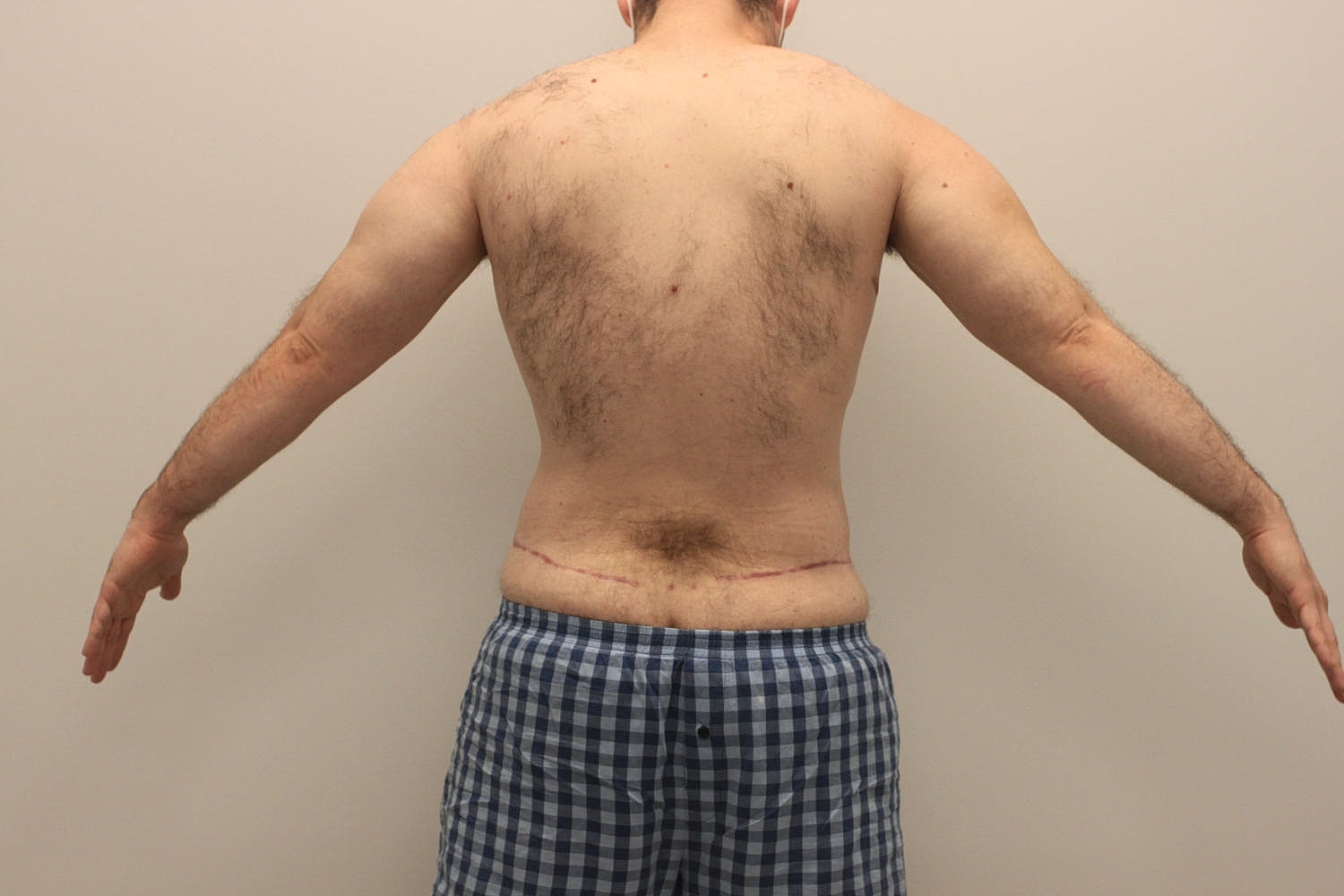 Male Body Contouring Before & After