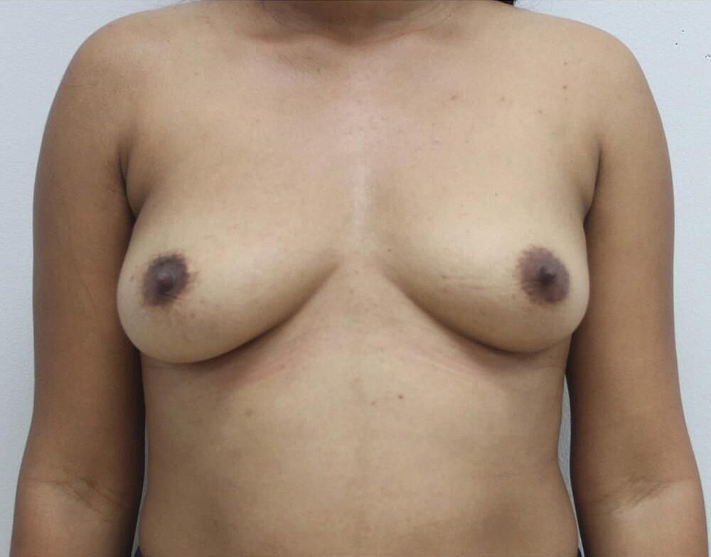 Breast New Before & After