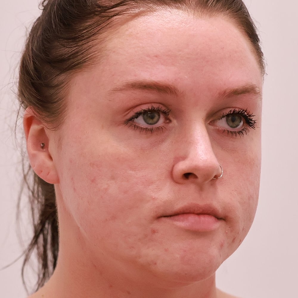 Microneedling Before & After