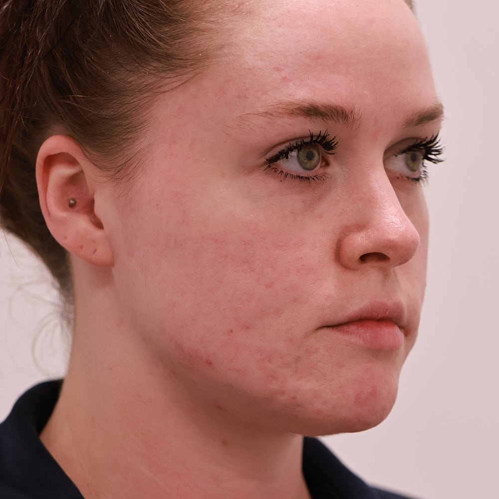 Microneedling Before & After