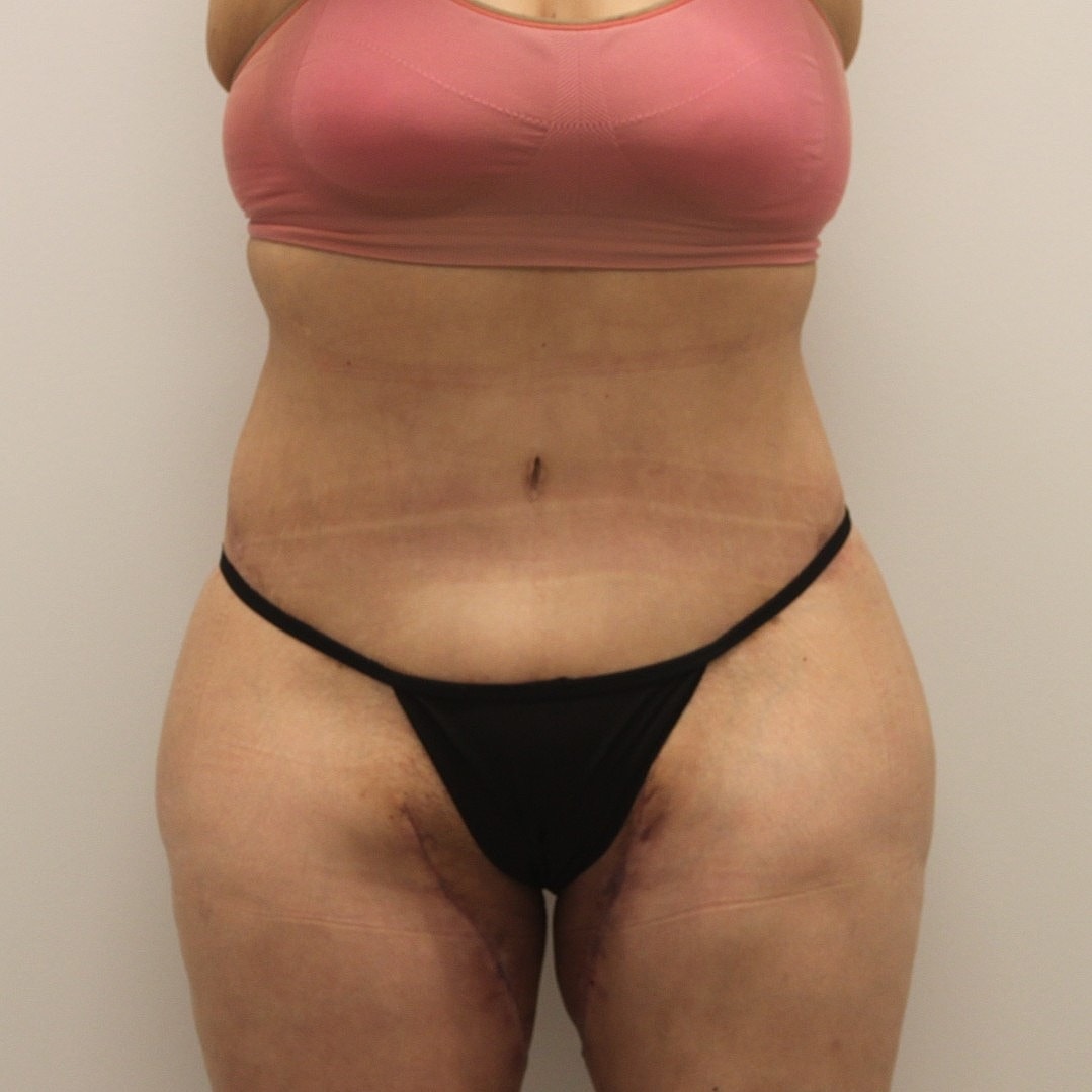 Circumferential Body Lift Before & After