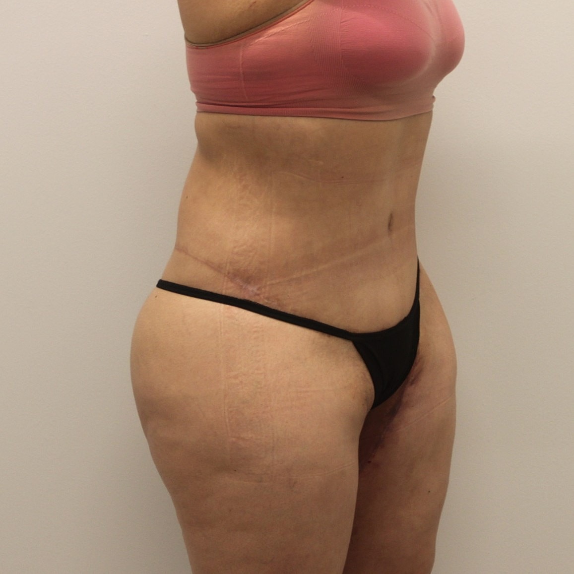Circumferential Body Lift Before & After