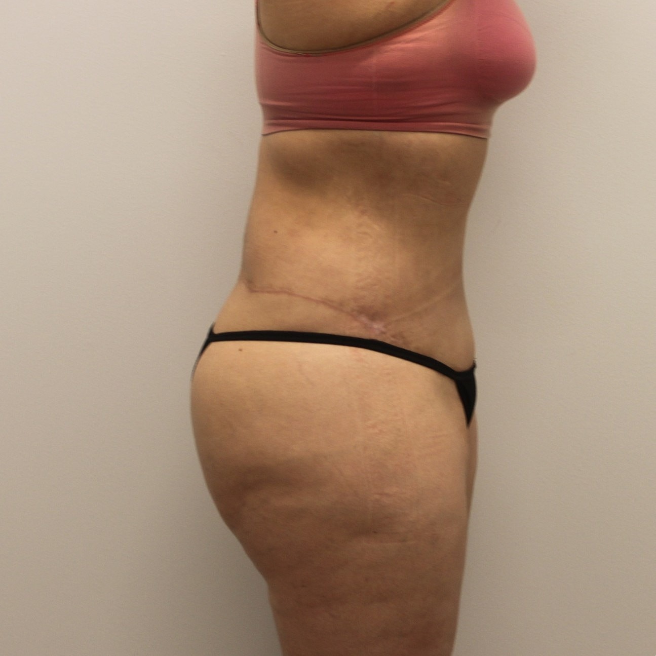 Circumferential Body Lift Before & After