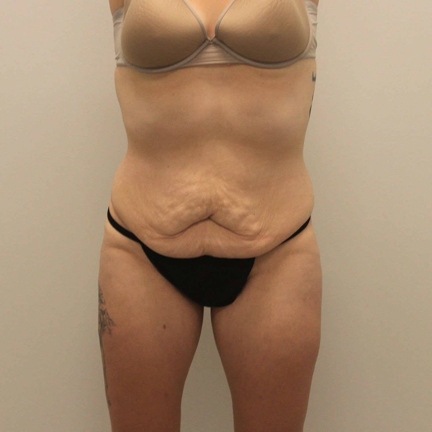 Circumferential Body Lift Before & After