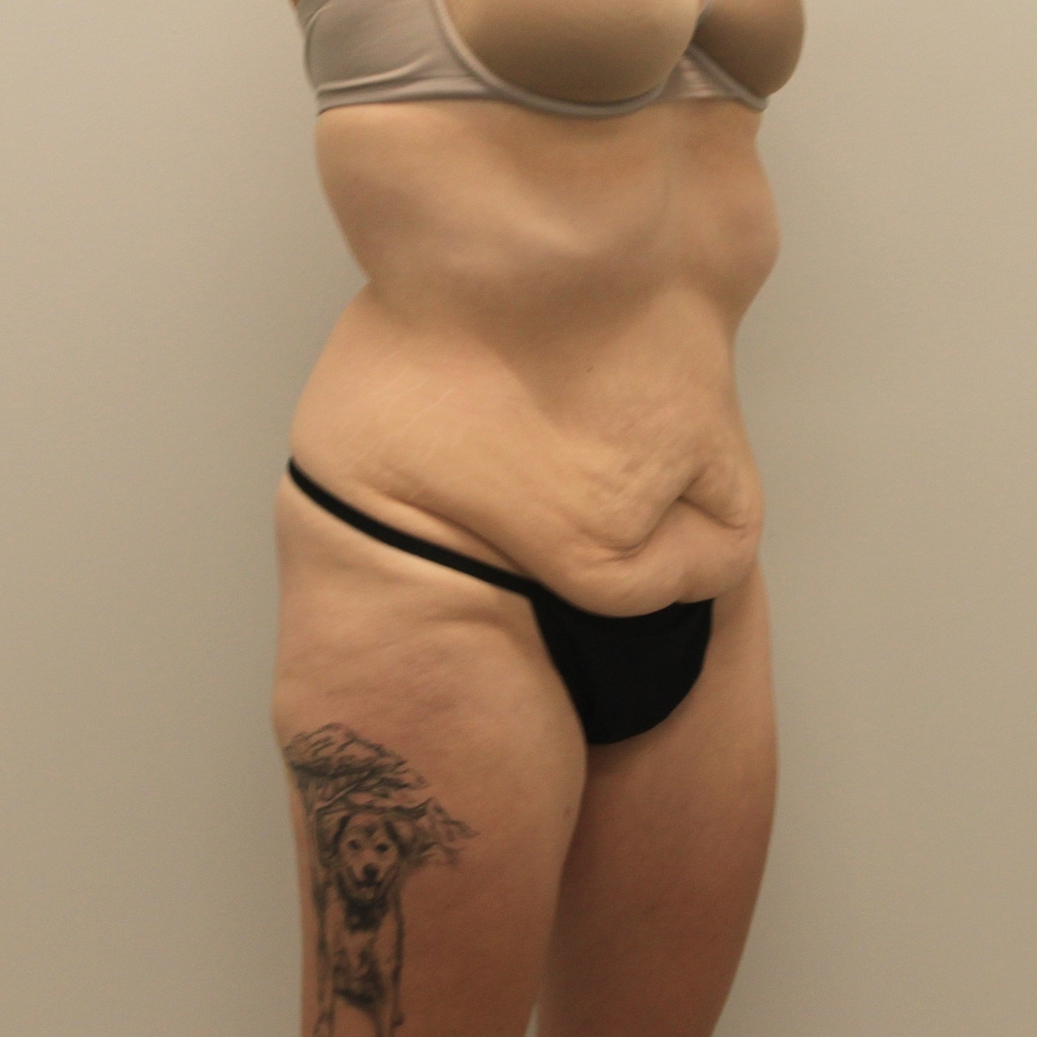 Circumferential Body Lift Before & After