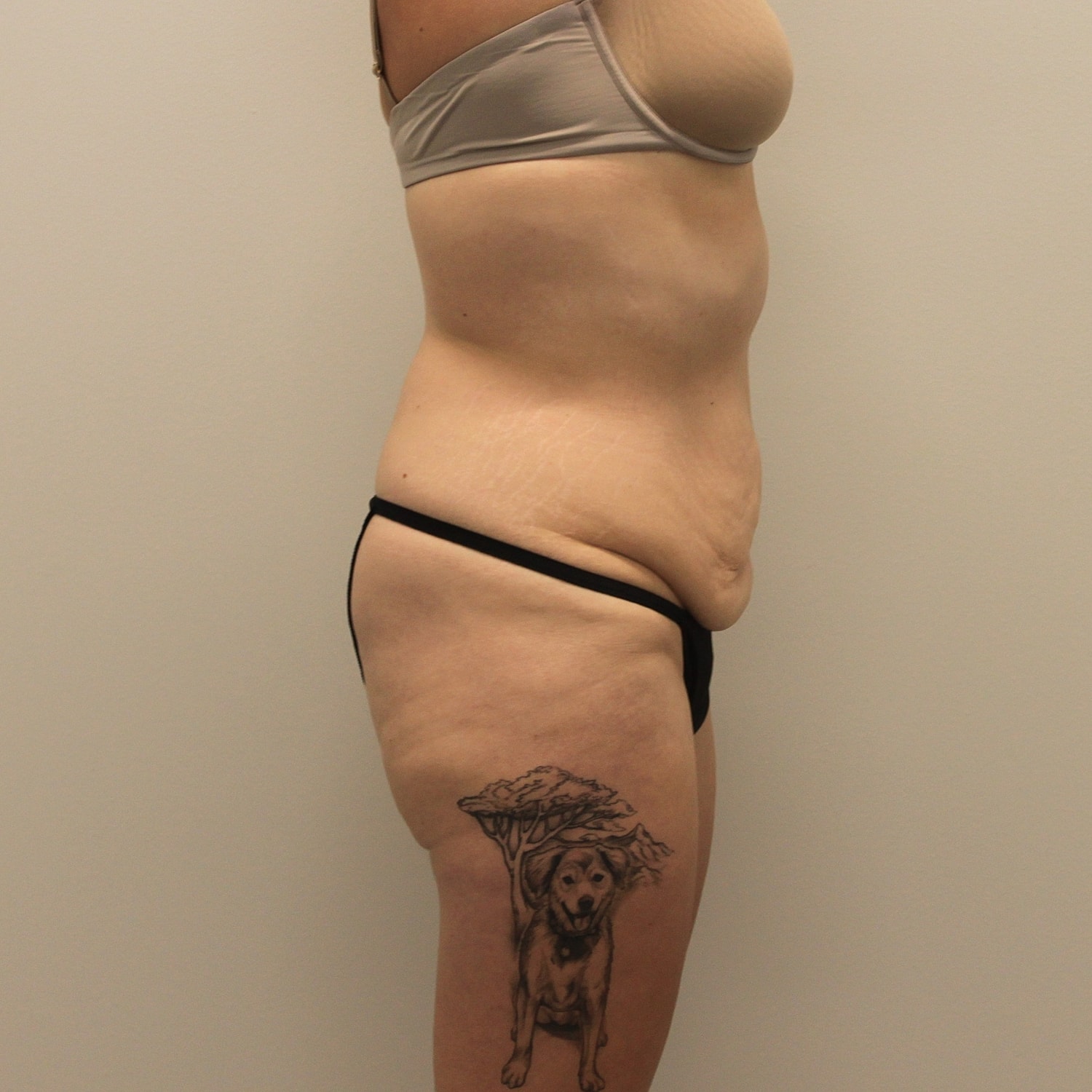 Circumferential Body Lift Before & After