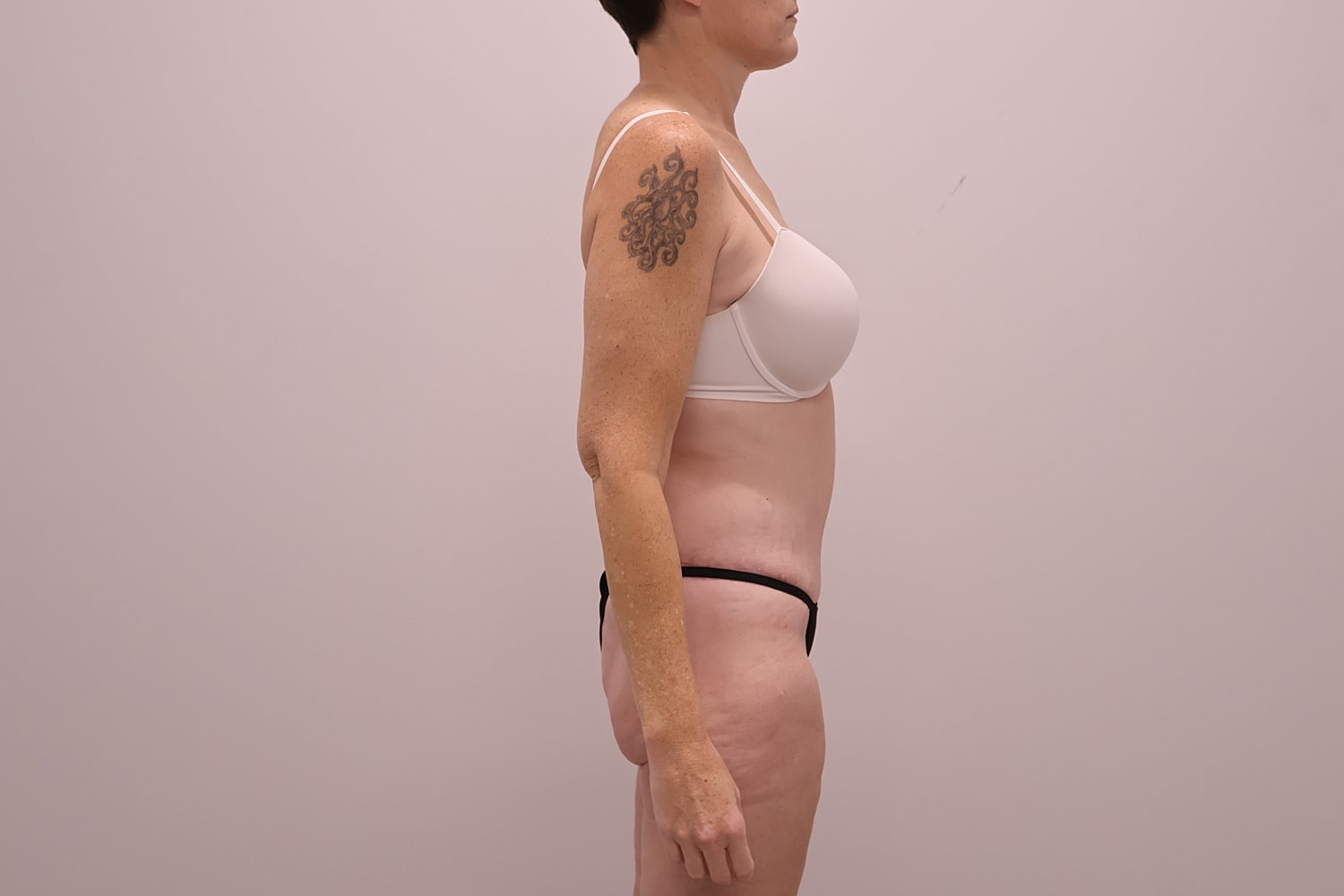 Circumferential Body Lift Before & After