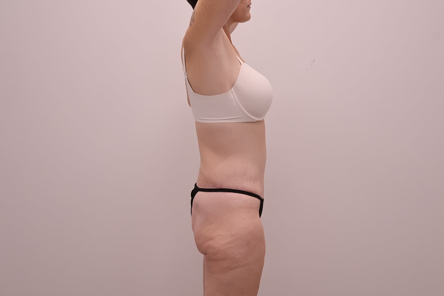 Circumferential Body Lift Before & After