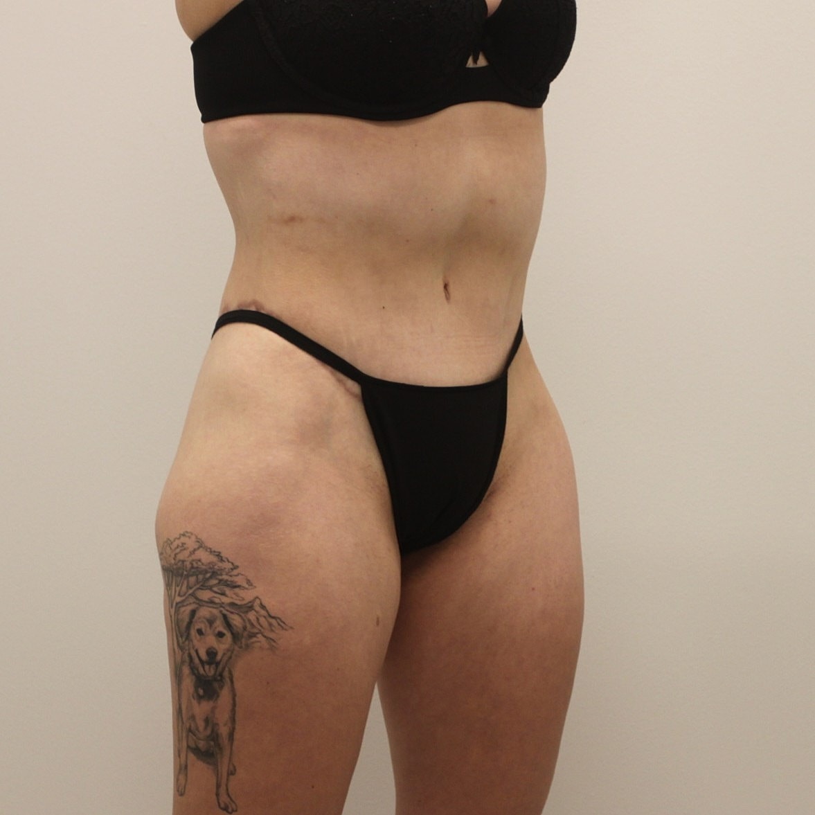 Circumferential Body Lift Before & After