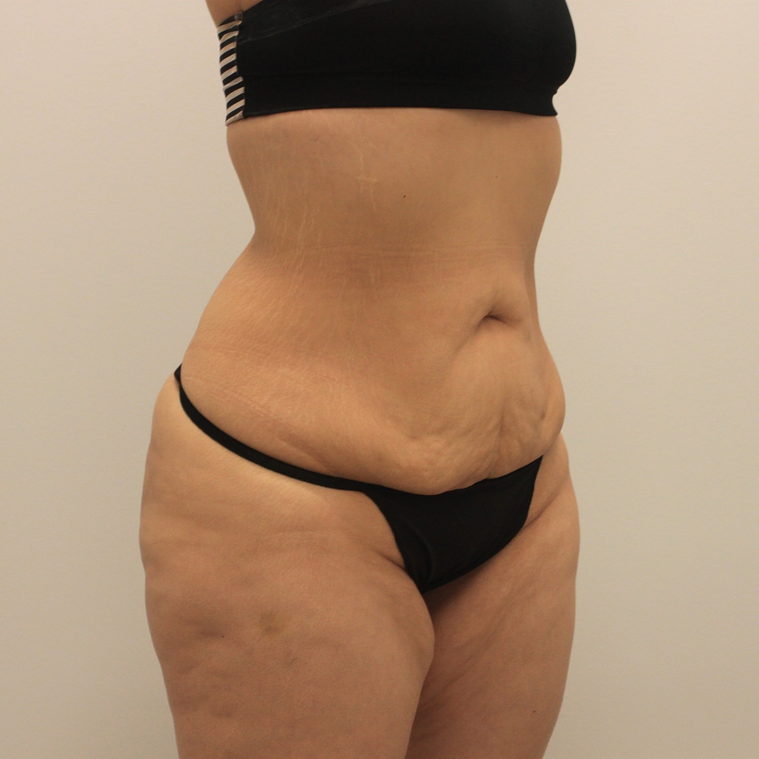 Circumferential Body Lift Before & After
