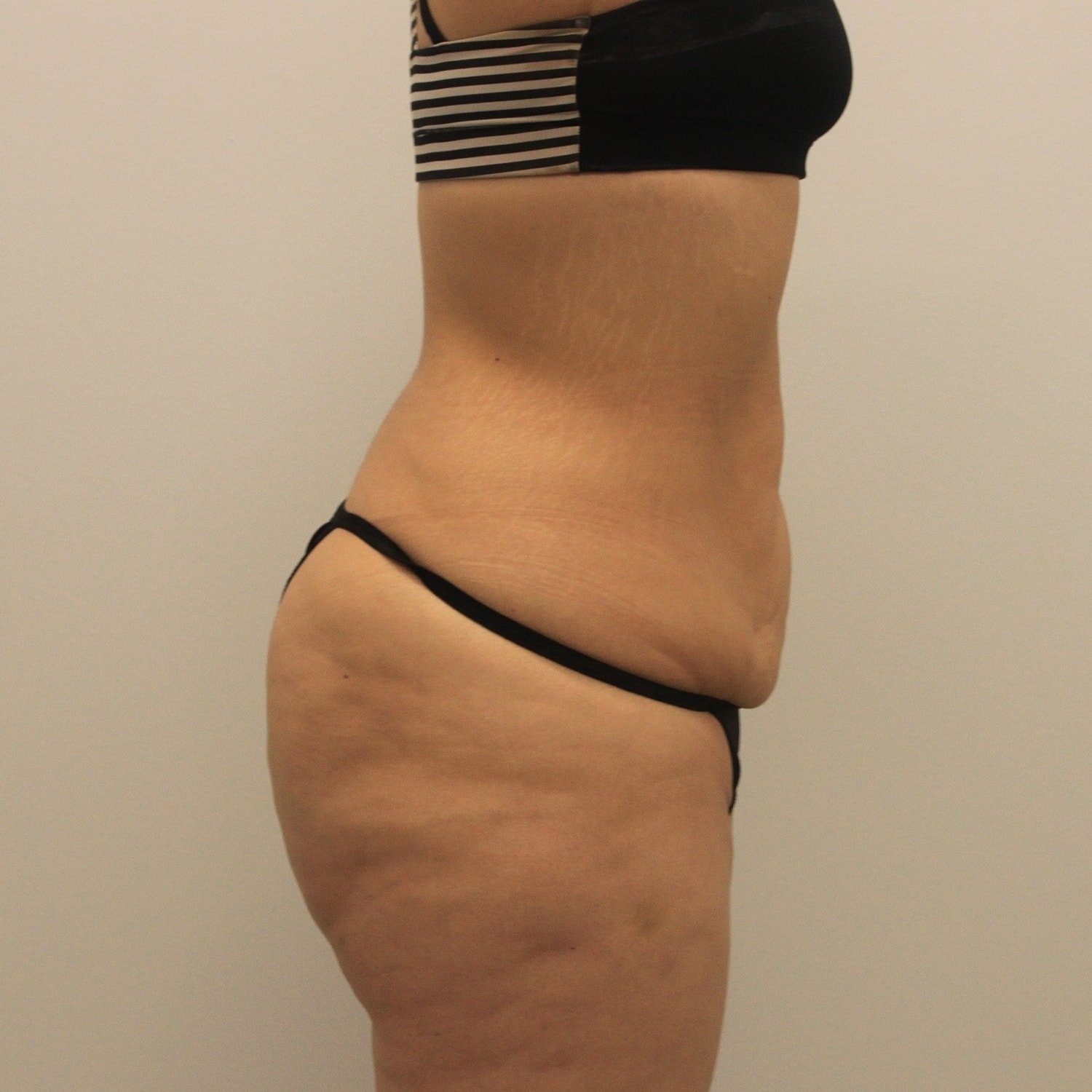 Circumferential Body Lift Before & After
