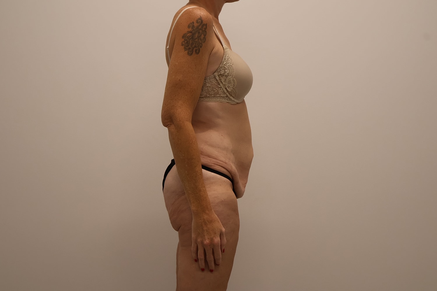 Circumferential Body Lift Before & After