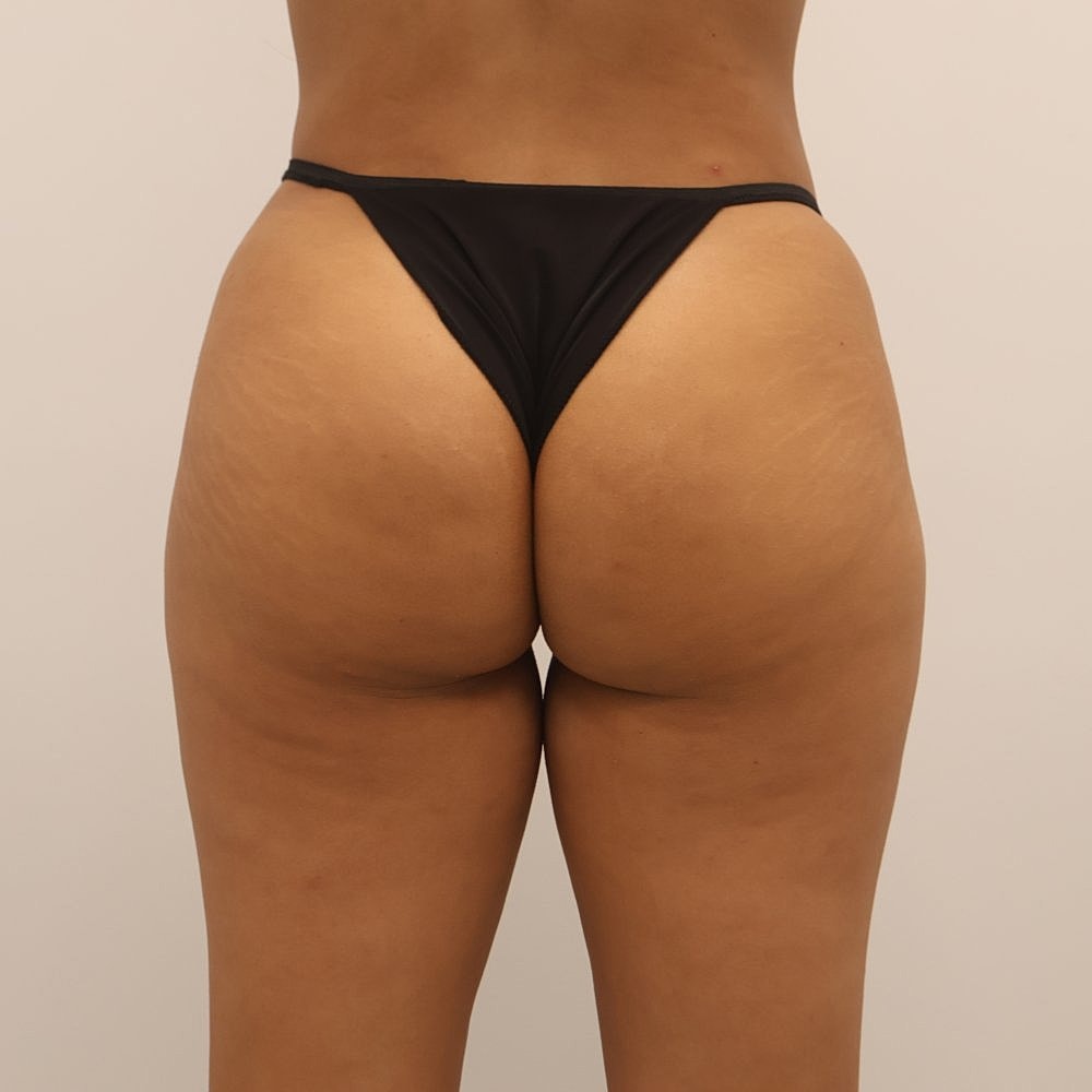 Sculptra Buttock Augmentation Before & After