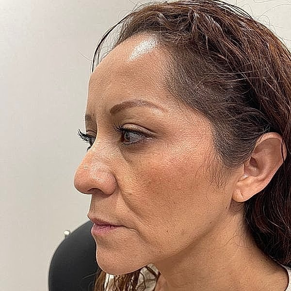 Dermal Filler Before & After