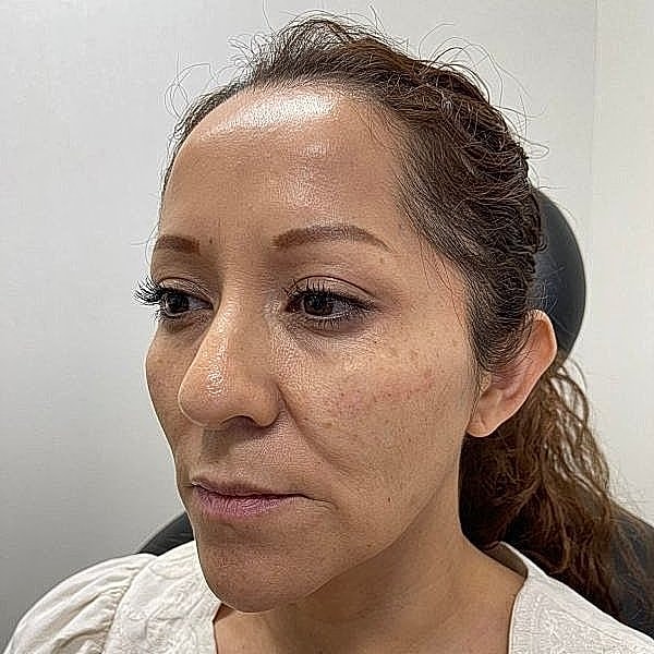 Dermal Filler Before & After