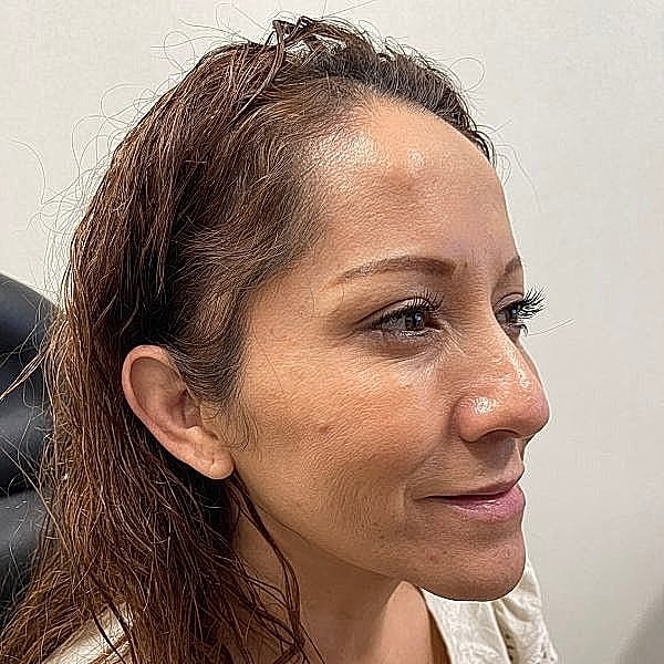 Dermal Filler Before & After