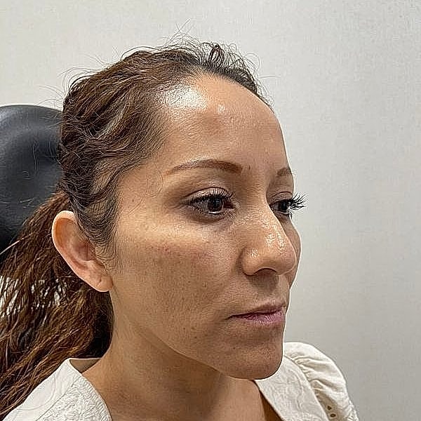 Dermal Filler Before & After