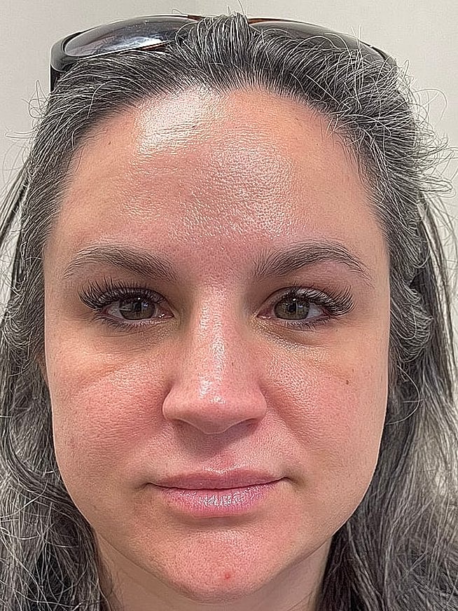 Dermal Filler Before & After