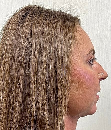 Dermal Filler Before & After