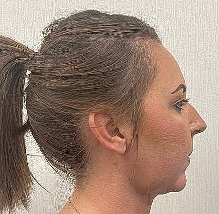 Dermal Filler Before & After