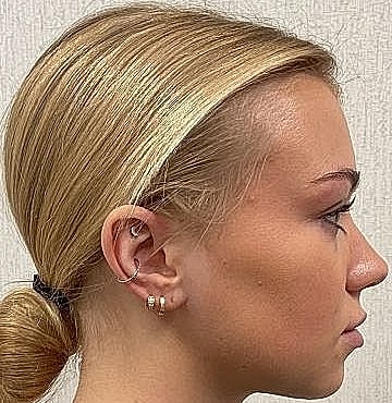 Dermal Filler Before & After