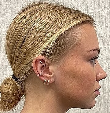 Dermal Filler Before & After