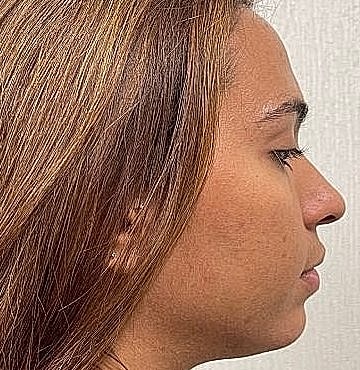 Dermal Filler Before & After