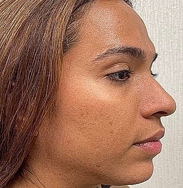 Dermal Filler Before & After