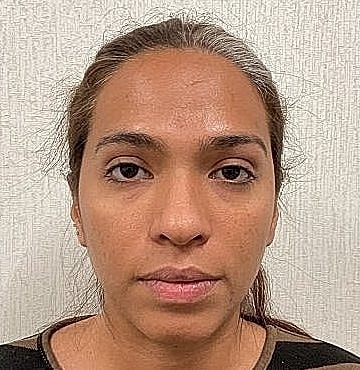 Dermal Filler Before & After